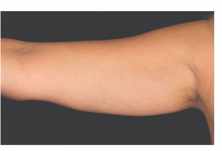 Arm fat After CoolSculpting Body Contouring fat loss Treatment in Montreal