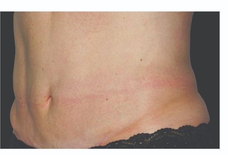 After CoolSculpting Body Contouring fat loss Treatment in Montreal