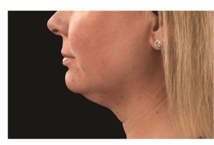 Sagging Double chin Before CoolSculpting Body Contouring fat loss Treatment in Montreal