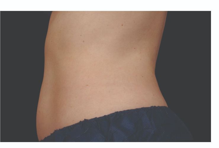 Abdomen and waist after CoolSculpting Body Contouring fat loss Treatment in Montreal