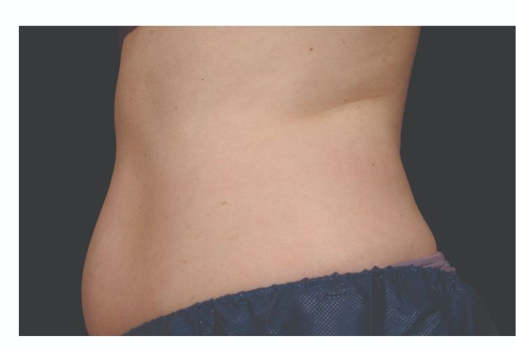 Abdomen and waist Before CoolSculpting Body Contouring fat loss Treatment in Montreal