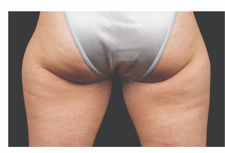 Glutes and thighs Before CoolSculpting Body Contouring fat loss Treatment in Montreal