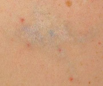 Before Fotona Laser Skin tattoo removal - Montreal