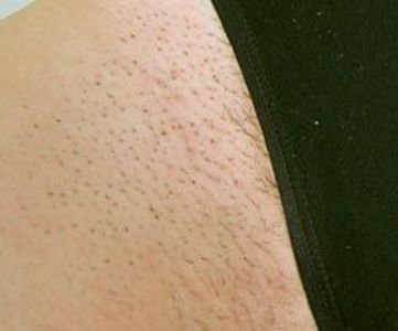 Before Fotona Laser Skin Treatment for bikini hair removal - Montreal