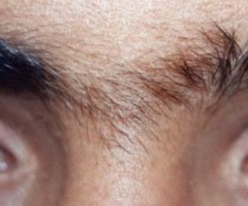 Before Fotona Laser Skin Treatment for facial hair removal - Montreal