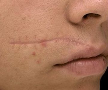 Before Fotona Laser Skin Treatment for scar removal - Montreal