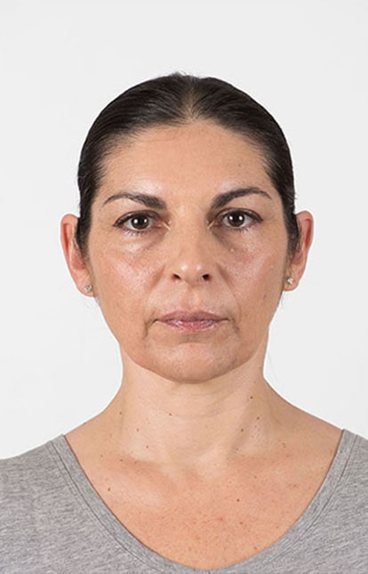 Before Aesthetic Hyaluronic acid dermal fillers injectables in Montreal