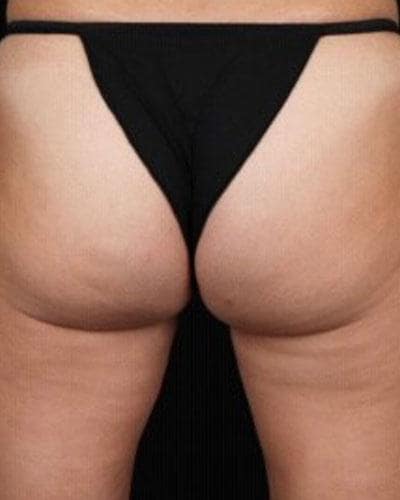 Before Profound Radiofrequency Microneedling glutes and thighs treatment - Montreal