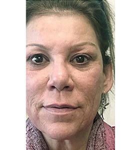 Patient before Scarlet-S RF treatment for wrinkles - Ideal Body Clinic Montreal