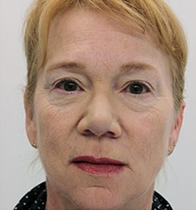 Patient after rejuvenate Scarlet-S RF treatment - Ideal Body Clinic Montreal