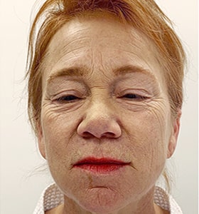 Patient before rejuvenate Scarlet-S RF treatment - Ideal Body Clinic Montreal