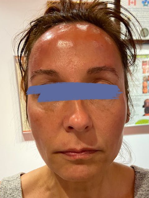 Female marionette lines after PDO thread lift procedure at our Montreal, Quebec aesthetic clinic