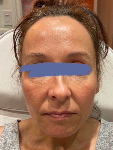 Female marionette lines before Before and After of PDO thread lift procedure at our Montreal, Quebec aesthetic clinic