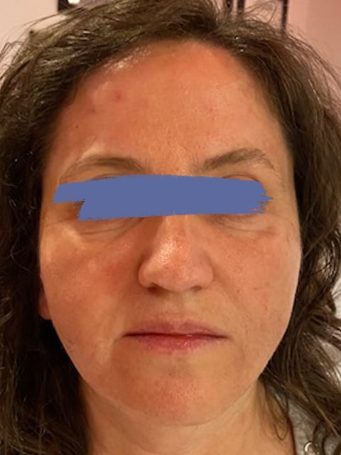 Female marionette lines after PDO thread lift procedure at our Montreal, Quebec aesthetic clinic