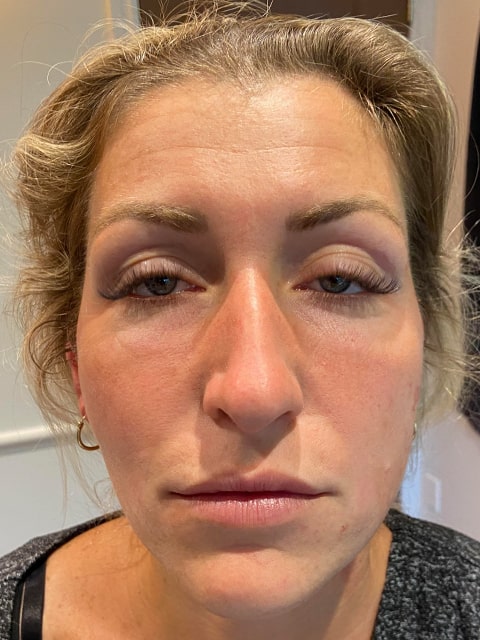 Droopy eyes and jaw before PDO thread lift procedure at our Montreal, Quebec aesthetic clinic
