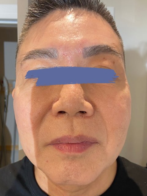 Male chin and jaw after PDO thread lift procedure at our Montreal, Quebec aesthetic clinic