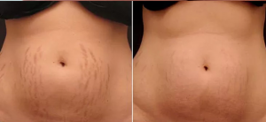 stretch marks