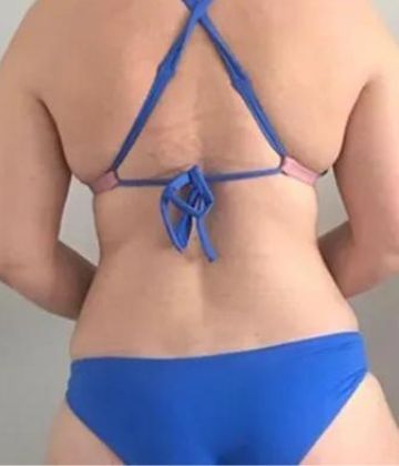 Graisse du ventre après Slimwave chez Ideal Body Clinic