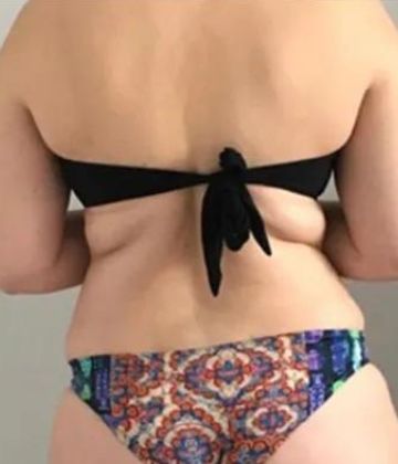 Graisse du ventre avant Slimwave chez Ideal Body Clinic