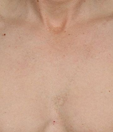 Détatouage Montréal, photo après de la poitrine d'un patient avec CUTERA Enlighten