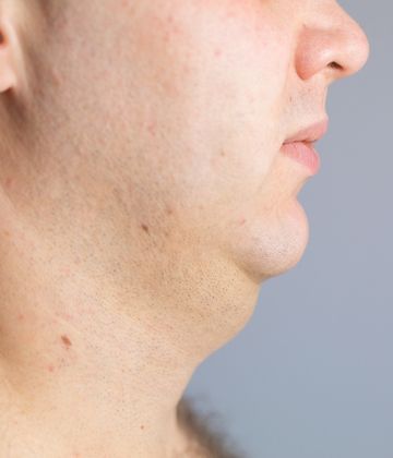 Belkyra Belkyra before and after pictures in Montreal