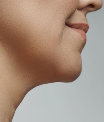  Belkyra Treatments for double chin in Montreal After pictures