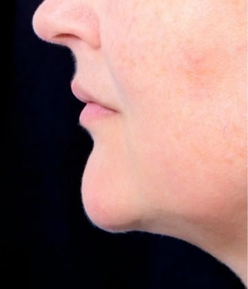 After Belkyra Treatments for double chin in Montreal