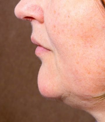 Before Belkyra Treatments for double chin in Montreal