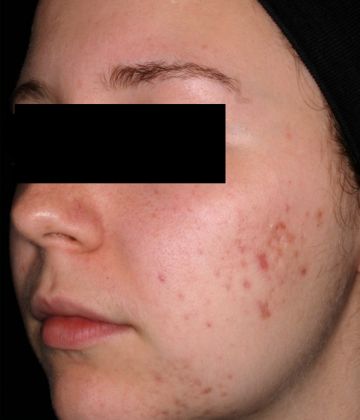 Avant le traitement d’élimination de l’acné au laser, Montreal