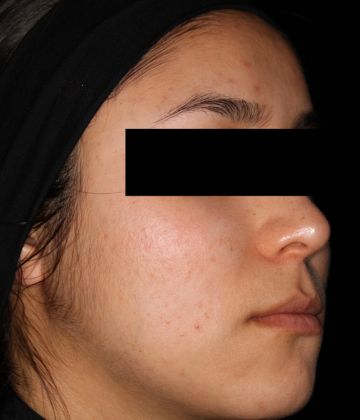 Après d’élimination de l’acné au laser à Montréal