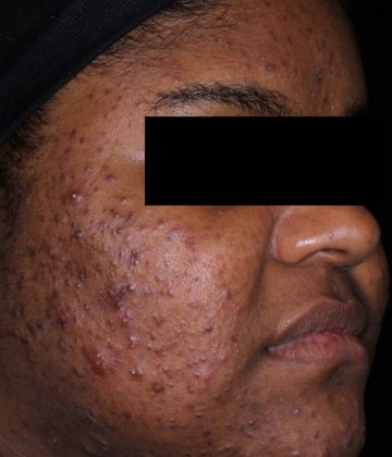 Avant le traitement d’élimination de l’acné au laser AviClear à la Clinique Corps Idéal, Montréal