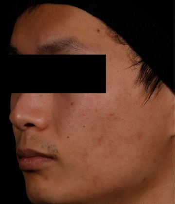 Après le traitement d’élimination de l’acné au laser AviClear à Montréal