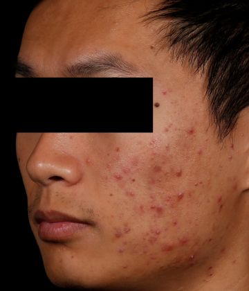 Avant le traitement d’élimination de l’acné au laser AviClear à Montréal