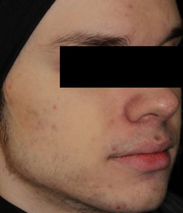 Après le traitement d’élimination de l’acné au laser à Montréal