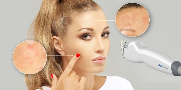 élimination de l'acné au laser aviclear à la Clinique Corps Idéal à Montréal