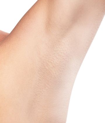 under arms (armpits) laser hair removal after picture treatment in Montreal