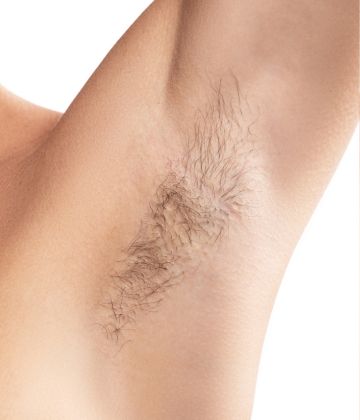 under arms (armpits) laser hair removal before treatment in Montreal