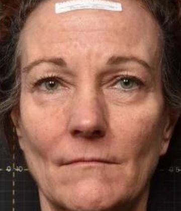 Sofwave de resserrement de la peau avant