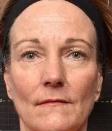  Sofwave de resserrement de la peau après