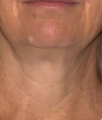 Photo du traitement Sofwave du visage après à Montréal