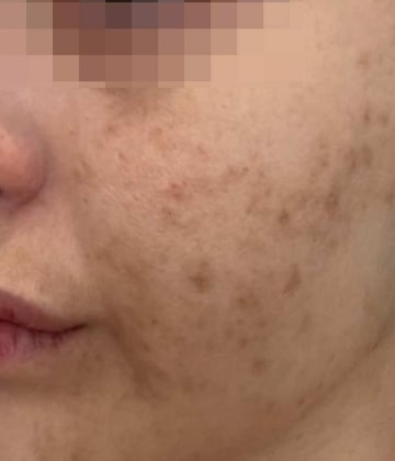 Before Secret Pro by Cutera for acne and acne scars - Montreal